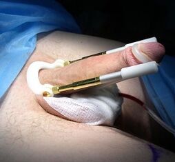 How is the operation to increase penis