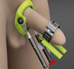 Rehabilitation after the operation to increase penis
